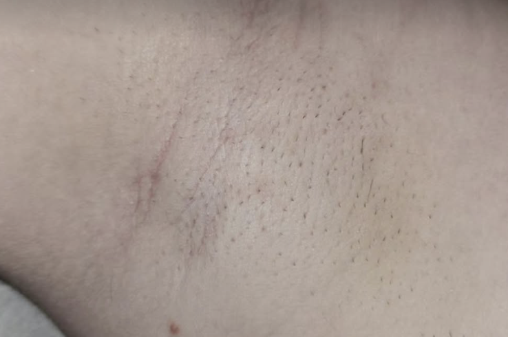 Before Laser Hair Removal